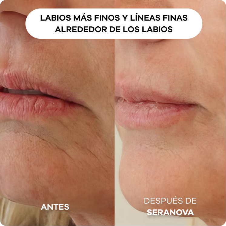 Sistema de Infusión con Microneedling™
