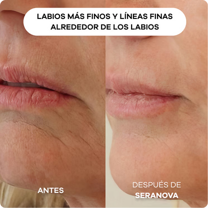 Sistema de Infusión con Microneedling™