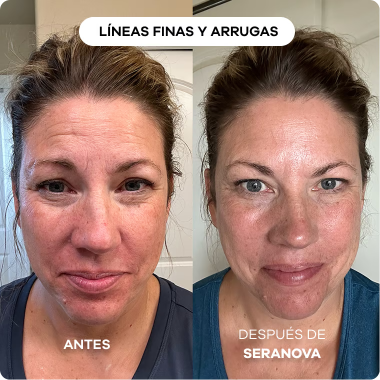 Sistema de Infusión con Microneedling™