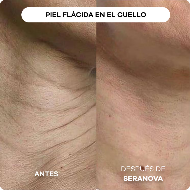 Sistema de Infusión con Microneedling™