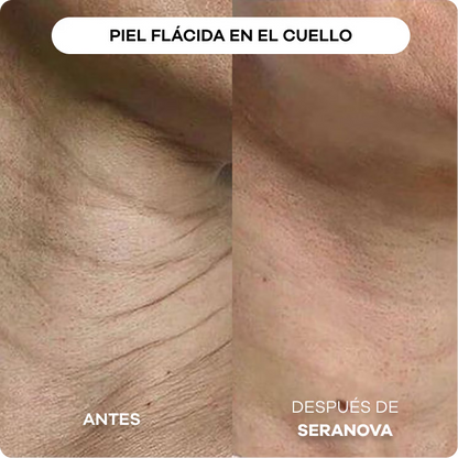 Sistema de Infusión con Microneedling™