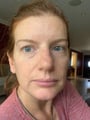 files/MicroneedlingR1.jpg