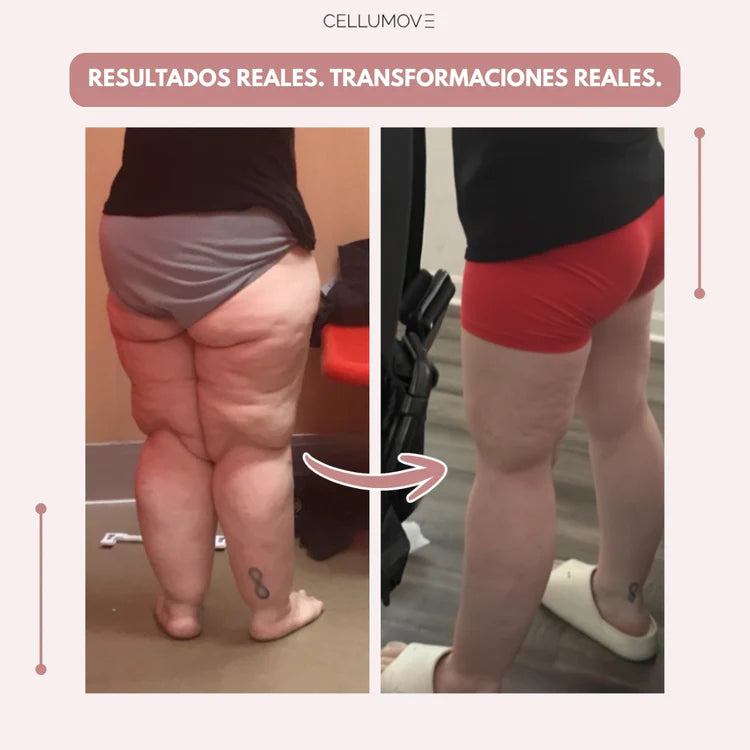 CELLUMOVE 3D – Despídete del dolor y la fatiga del lipedema de forma natural