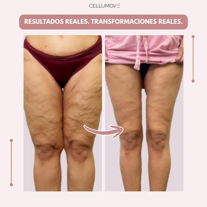 CELLUMOVE 3D – Despídete del dolor y la fatiga del lipedema de forma natural