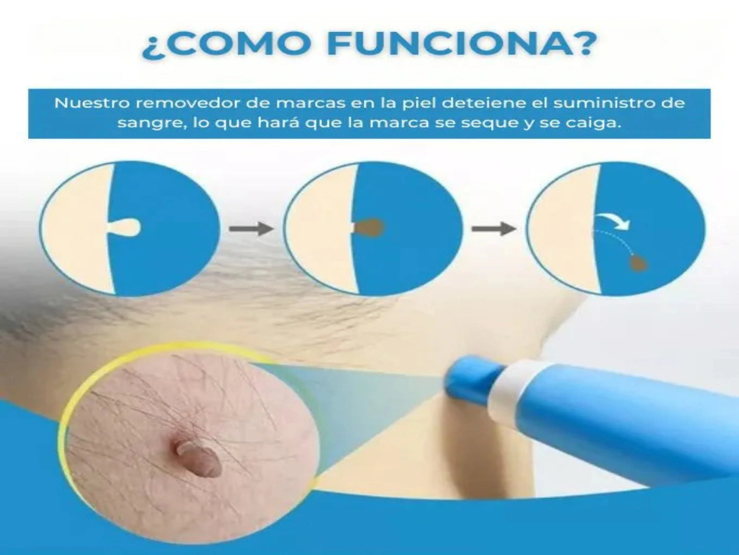 KIT QUITA VERRUGAS