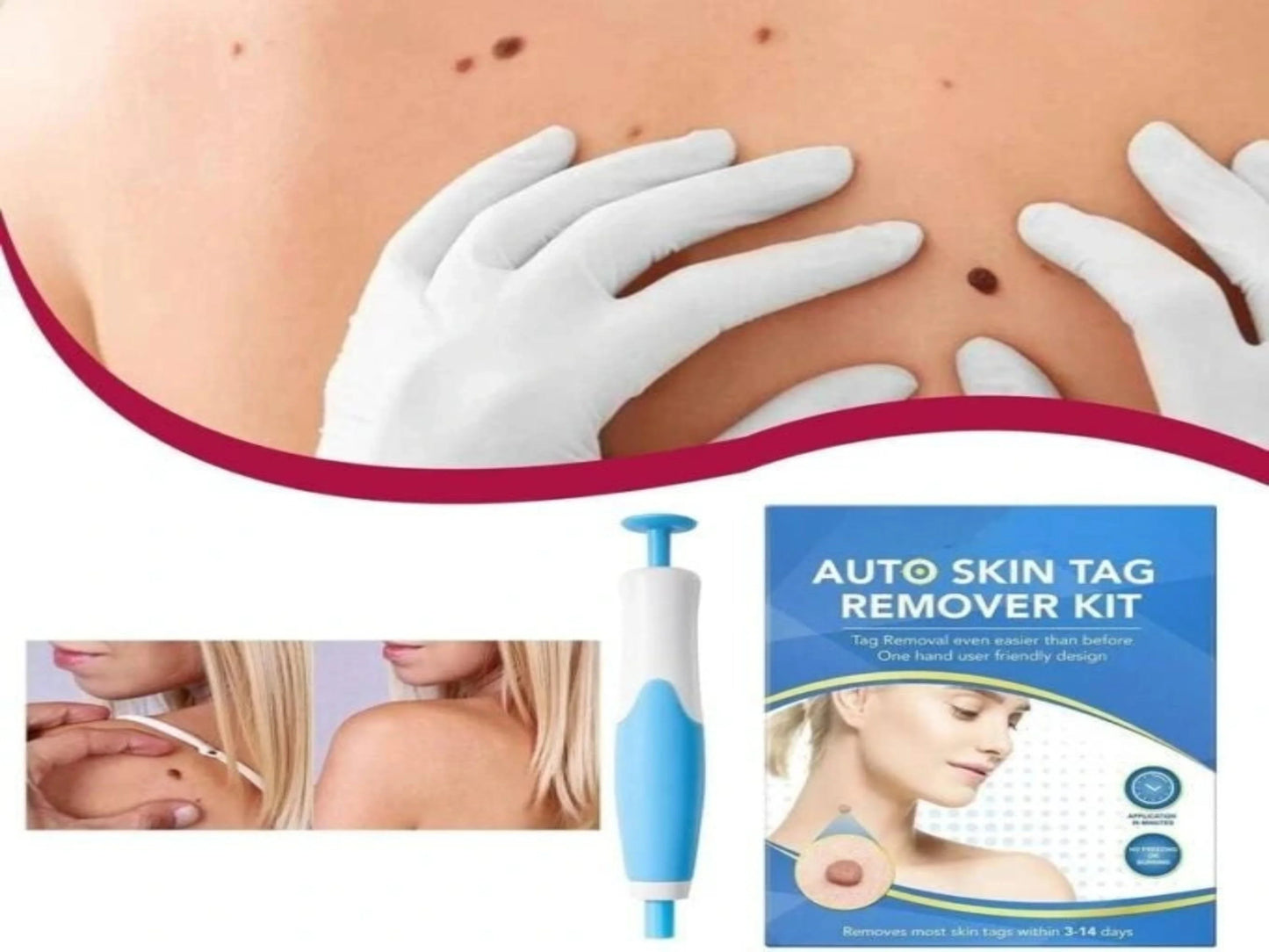 KIT QUITA VERRUGAS